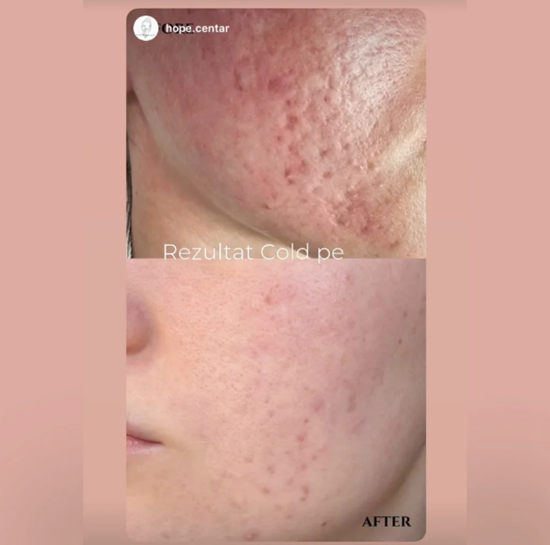 MELAPRO PLUS COLD PEEL 10 ampoules × 3 ml