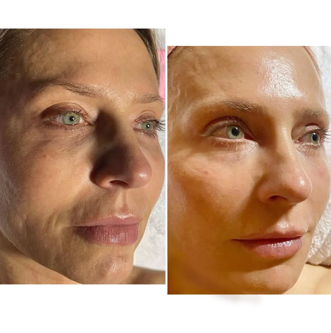 V-TOX LIFT MASK 100 ml